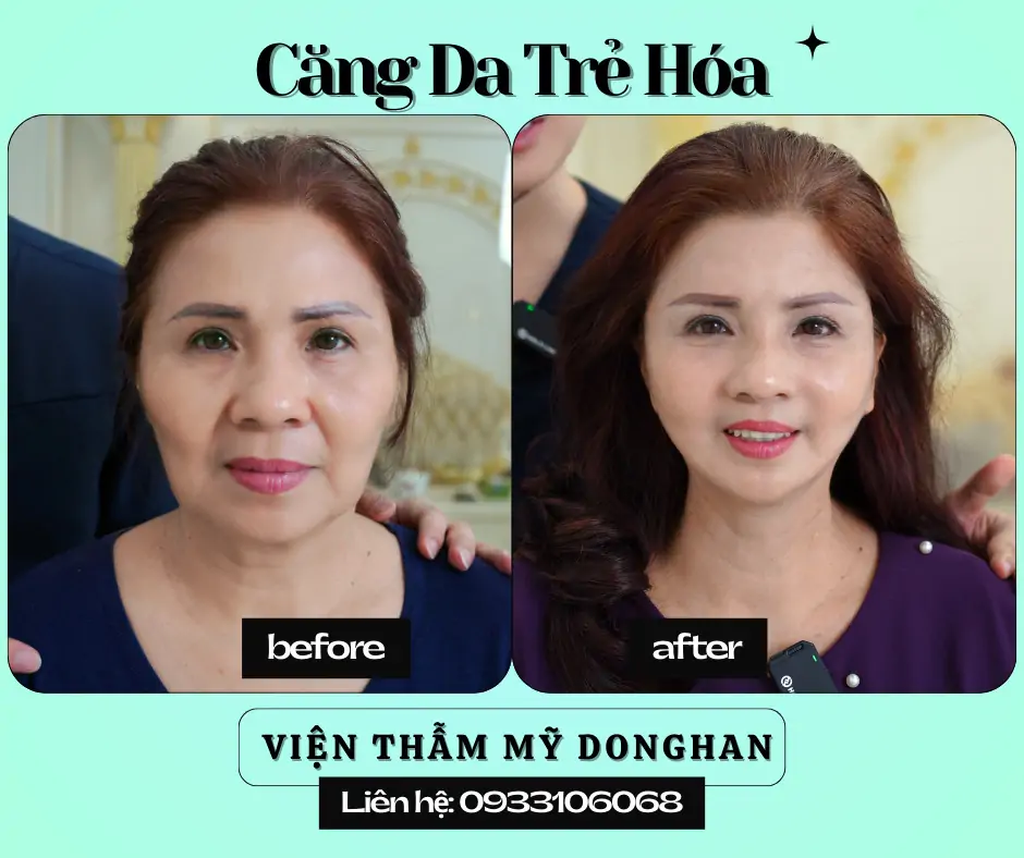 Nhấn Nhân Trung Thẩm Mỹ – Tạo Điểm Nhấn Thanh Tú Cho Gương Mặt