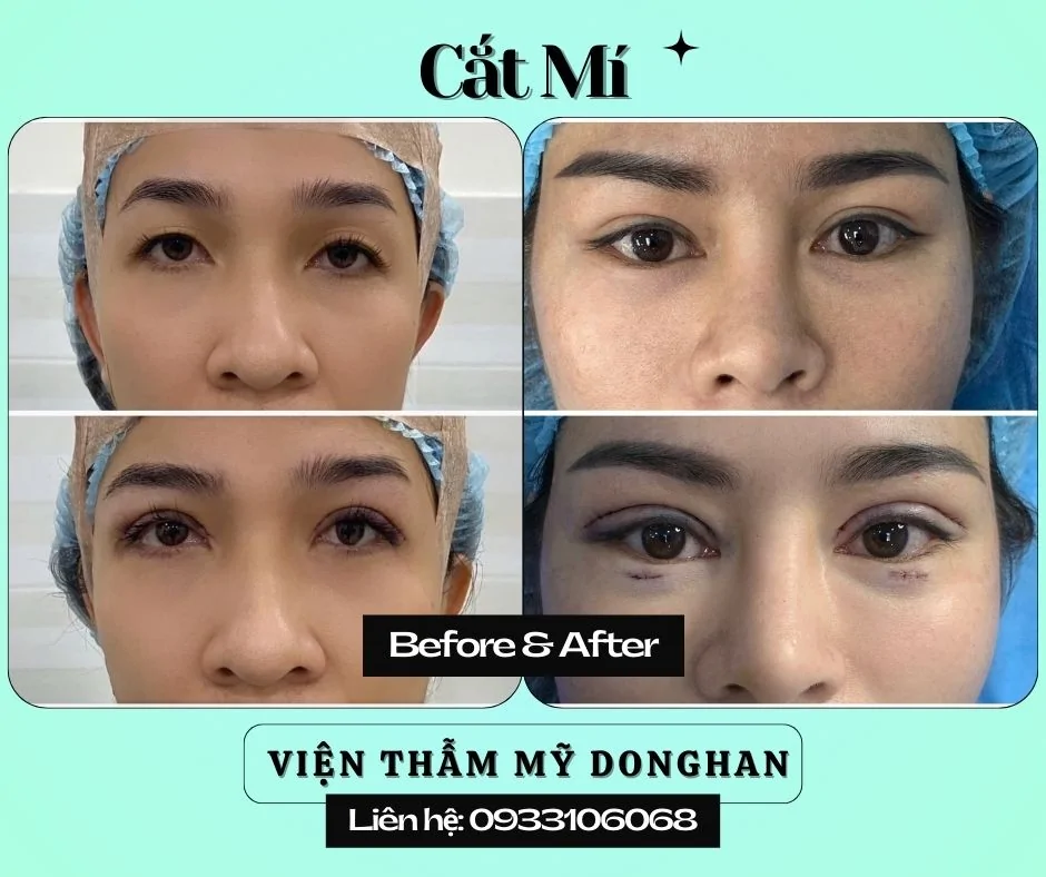 Nhấn Nhân Trung Thẩm Mỹ – Tạo Điểm Nhấn Thanh Tú Cho Gương Mặt