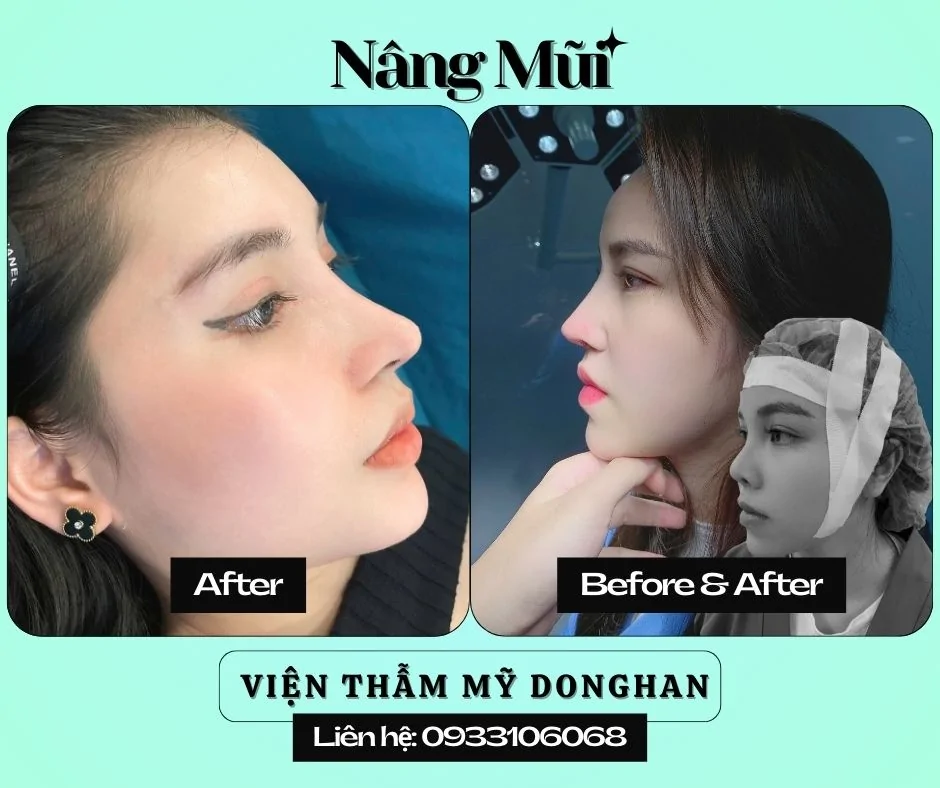 Nhấn Nhân Trung Thẩm Mỹ – Tạo Điểm Nhấn Thanh Tú Cho Gương Mặt