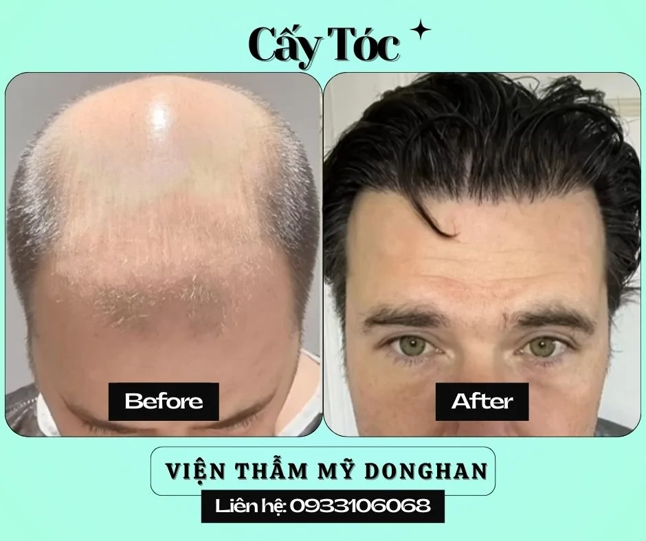 Nhấn Nhân Trung Thẩm Mỹ – Tạo Điểm Nhấn Thanh Tú Cho Gương Mặt