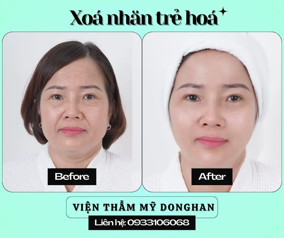 Nhấn Nhân Trung Thẩm Mỹ – Tạo Điểm Nhấn Thanh Tú Cho Gương Mặt