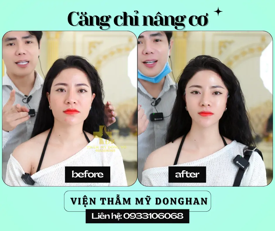 Nhấn Nhân Trung Thẩm Mỹ – Tạo Điểm Nhấn Thanh Tú Cho Gương Mặt