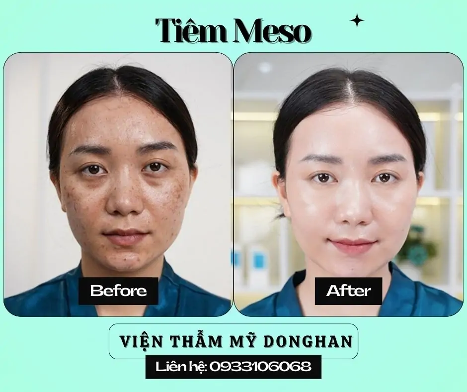 Nhấn Nhân Trung Thẩm Mỹ – Tạo Điểm Nhấn Thanh Tú Cho Gương Mặt