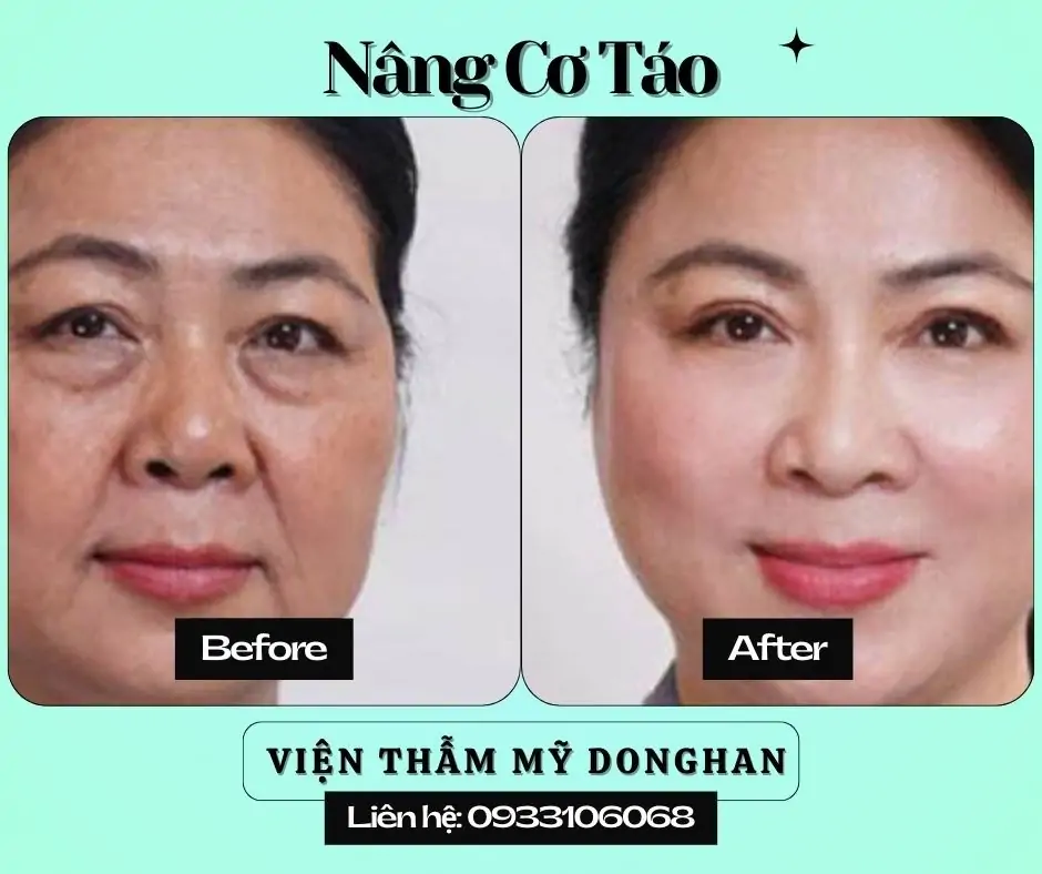 Nhấn Nhân Trung Thẩm Mỹ – Tạo Điểm Nhấn Thanh Tú Cho Gương Mặt